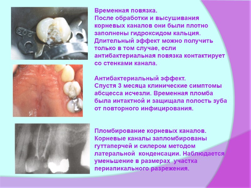 Временная повязка. После обработки и высушивания корневых каналов они были плотно заполнены гидроксидом кальция.